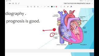 valvular heart disease [upl. by Monson703]