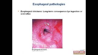 GIT pathology Barrett esophagus Achalasia video part 1 from USMLE First Aid Step One [upl. by Borek]