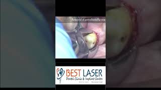 Receded molar and premolar extraction in 40 seconds by DrCMurugavel [upl. by Banquer794]