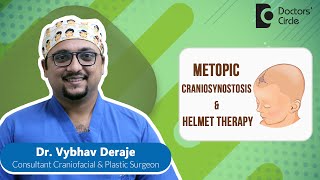 Triangular Forehead  Metopic Synostosis amp Helmet Therapy baby  DrVybhav Deraje  Doctors Circle [upl. by Nevaeh]