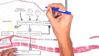 Burns DETAILED Overview  Types Pathophysiology TBSA [upl. by Miarfe81]