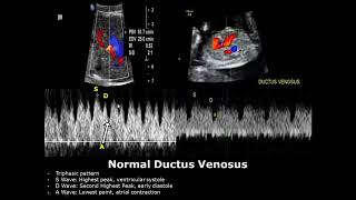 Fetal Ductus Venosus Doppler Ultrasound Normal Vs Abnormal Image Appearances  Spectral Doppler USG [upl. by Bigod]