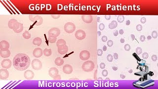 G6PD deficiency patient Blood Picture [upl. by Ransome654]