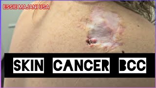 Skin Cancer misdiagnosed Basal Cell Carcinoma 😞😢 [upl. by Cattima]