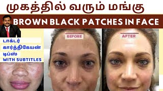 மங்கு மறைய டிப்ஸ்Home remedies to remove brown black patches spots hyperpigmentation on face skin [upl. by Niltiac]