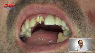 36Fratura dental total Como reutilizar o próprio dente com pino de fibra de vidroDr Antônio [upl. by Jacintha]