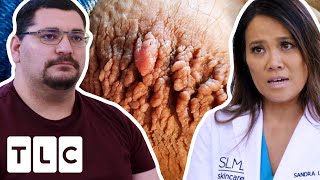 Rupturing Thigh Chafing Keeps Him From Fully Being Part Of His Family  Dr Pimple Popper [upl. by Yffub701]