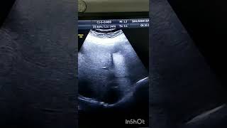 liver hydrated cyst liver ultrasound pocus cystic radiologytechnologist medical doctor [upl. by Other]