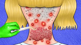 ASMR Collection to Cure Acne on the Back of the Neck  ASMR Animation [upl. by Onitsirc]