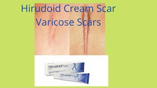 Hirudoid Forte and Hirudoid cream scar varicose bruses inflammation acne skin veins care [upl. by Klemens709]