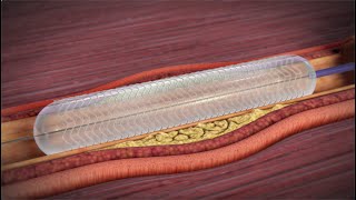 What is a Coronary Angioplasty [upl. by Goulden]