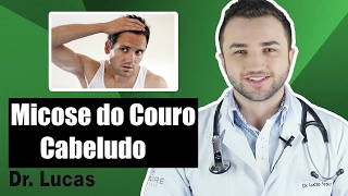 Micose do Couro Cabeludo Tinea capitis  Dr Lucas Fustinoni [upl. by Landy]