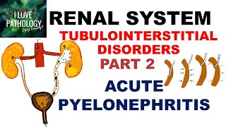 ACUTE PYELONEPHRITIS Pathology [upl. by Maiocco]