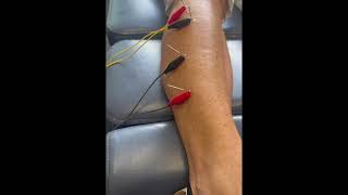 Dry needling now offered [upl. by Lonnie]