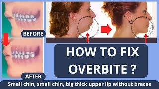 HOW TO FIX OVERBITE  SMALL CHIN BIG THICK UPPER LIP  WITHOUT BRACES NATURALLY [upl. by Lebyram425]