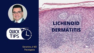 LICHENOID DERMATITIS PART I [upl. by Nahej]