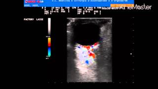 Embolic Central Retinal Artery Occlusion CRAO [upl. by Mcclimans]