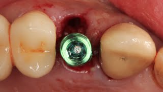 Immediate implant placement with CT graft in buccal pouch [upl. by Lenej]