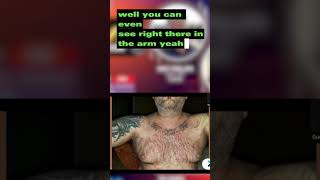 Episode 31 Lichenoid dermatitis scalp psoriasis and inverse psoriasis Part 2 prife testimonial [upl. by Durman]