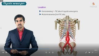 Mycotic Infected Aneurysms  Highyield Usmle step 1 pathology [upl. by Geis]