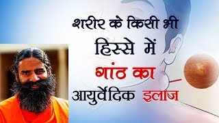 शरीर के किसी भी हिस्से में गांठ का आयुर्वेदिक इलाज  Swami Ramdev [upl. by Nagy]