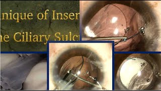 The Technique of inserting a 3 piece IOL into the ciliary Sulcus in a case of PCR [upl. by Seidel616]