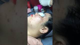 Big inflamed acne removal [upl. by Oiramal497]