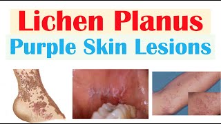 Lichen Planus “Purple Skin Lesions”  Causes Signs amp Symptoms Diagnosis Treatment [upl. by Geehan]