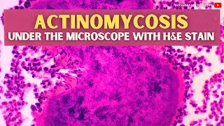 Actinomycosis under the microscope with Haematoxylin and Eosin HampE stain [upl. by Verene]