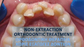 Nonextraction orthodontic treatment Pt BE [upl. by Ramah]