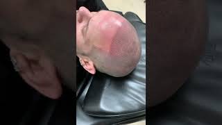 Scalp MicroPigmentation South Carolina amp North Carolina [upl. by Baynebridge]