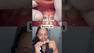 Dental Hygienist explains shorts braceson [upl. by Alodee]