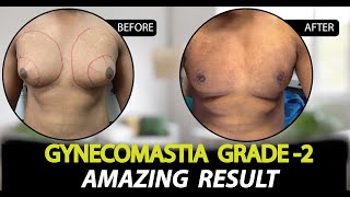 Gynecomastia Surgery in Jaipur  Patient Feedback  Dr Deepesh Goyal  Rejuvena Cosmo Care [upl. by Ahsemad]