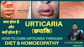 क्या है छपाकिURTICARIAकैसे करे इसे DIET और होमियोपैथी से ख़त्म URTICARIADIET amp HOMOEOPATHY [upl. by Yrtsed]