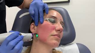 VBeam Perfecta pulse dye laser treatment for facial redness and rosacea by Dr Shaun Patel [upl. by Nnek]