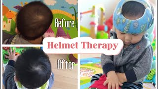 12 Weeks Progress Helmet Therapy For Flat Head SyndromePlagiocephaly [upl. by Miller]