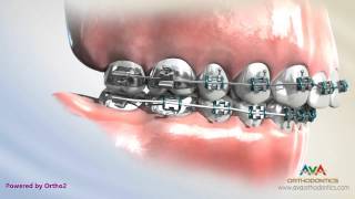 Orthodontics Treatment for Overjet Overbite  Headgear vs Forsus Appliance [upl. by Rebhun177]