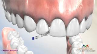 Interproximal Reduction or IPR  Polishing Strip [upl. by Seraphine853]