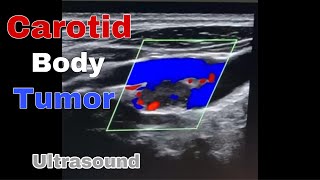 Carotid body tumor ultrasound features and differential diagnosis [upl. by Inaja]