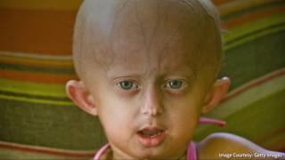 The Rare Disease Progeria Is Now Curable [upl. by Aigroeg541]