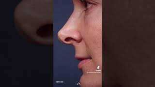 Ultimate Transformation Revision Rhinoplasty Nasal Airway Before and After [upl. by Eahc]