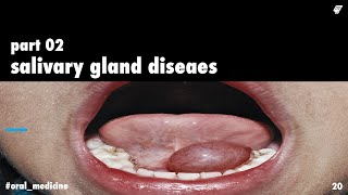 salivary gland diseases 2  oral medicine  عزت شومان [upl. by Oicelem]