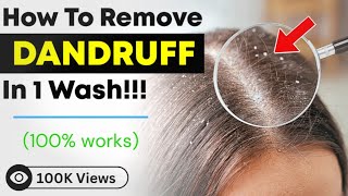 Get Rid Of DANDRUFF In 1 Wash😏💯 HINDI [upl. by Mechelle]