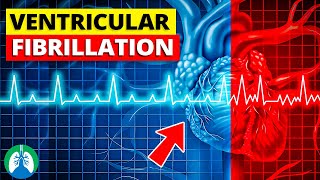 Ventricular Fibrillation Vfib  Medical Explainer Video [upl. by Willy]