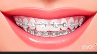 Dental Capping Treatment  Dental Crown Procedure Front Teeth [upl. by Uis]