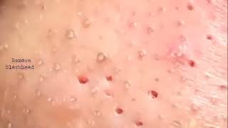 Blackhead Removal on his nose  Acne Treatment  Remove Blackhead removeblackhead [upl. by Zakaria]