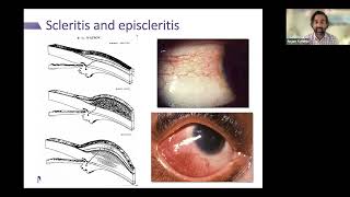 Scleritis vs Episcleritis 2023 [upl. by Linehan]