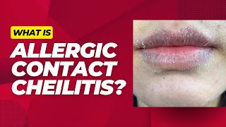 What is allergic contact cheilitis [upl. by Ttemme]