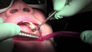 Canker sore treatment and relief at Sana Dental in Edmonton [upl. by Casimire]