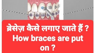 ब्रेसेज़ कैसे लगाए जाते हैं  braces clip bracestreatment dental oralhealth dentalclinic [upl. by Gwynne356]